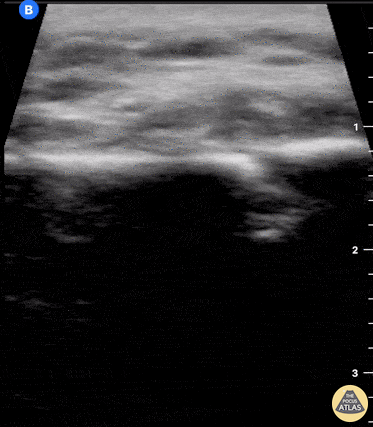 Musculoskeletal - Clavicle fracture with hematoma