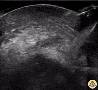 Orbital - Ruptured Globe