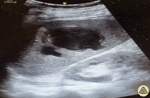 Trauma - Splenic hematoma with active extravasation