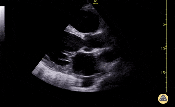 Left Ventricular Dysfunction - Reduced Ejection Fraction (Parasternal Long Axis View)