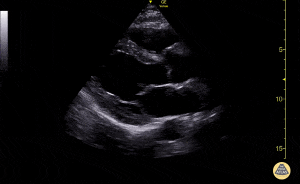 Normal Cardiac Anatomy - Normal Parasternal Long Axis (PLAX) View