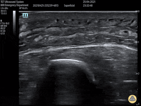 Soft Tissue - Post Stab Wound Cellulitis