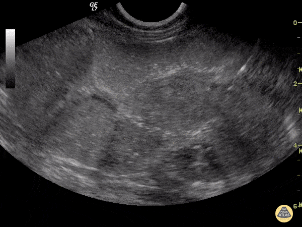 Bowel-GI - Intussusception