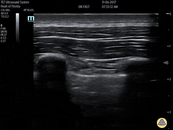 Pulmonary - No Lung Sliding