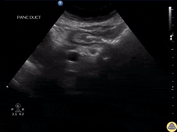 Bowel-GI - Pancreatic Duct Stones