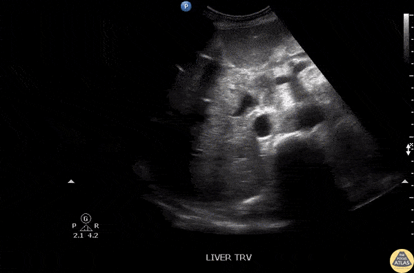 Biliary - Pneumobilia