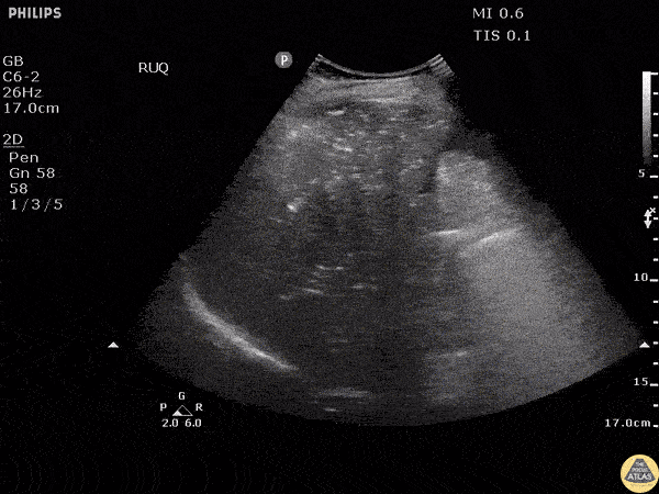 Biliary - Portal Venous Gas