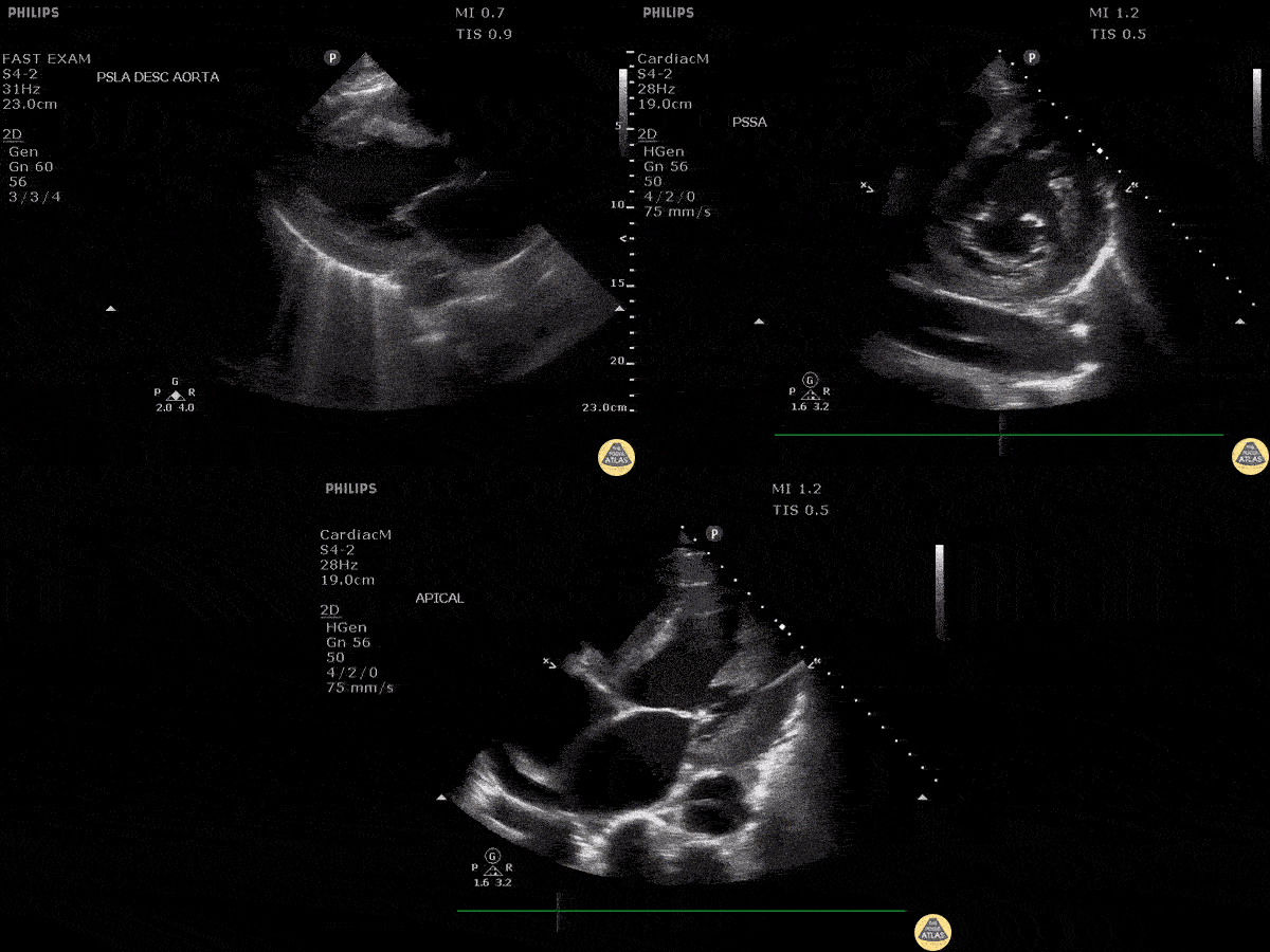 Aorta - Aortic Dissection