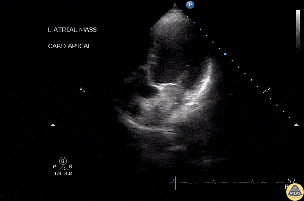 Cardiac Tumors - Left Atrial Myxoma