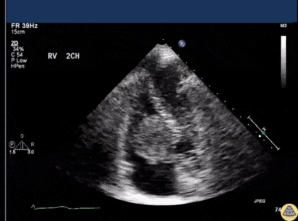 Cardiac Tumors - Right Atrial Myxoma