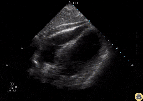 Pericardial Disease - Hemopericardium