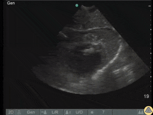 Pericardial Disease - Hemopericardium
