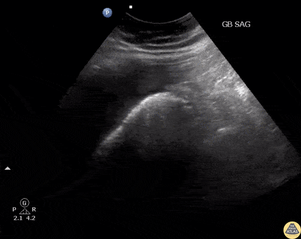 Biliary - Emphysematous Cholecystitis