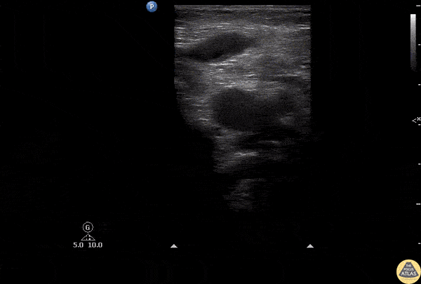 Vascular - Great Saphenous Thrombosis