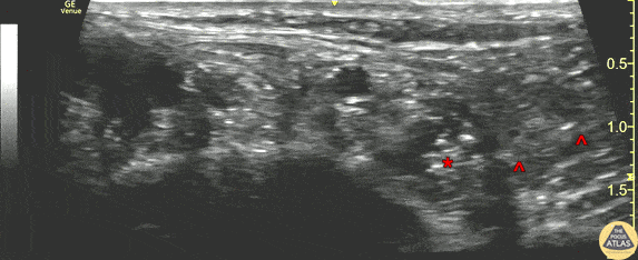 Nerve Block Gallery - Posterior Tibial Nerve Block