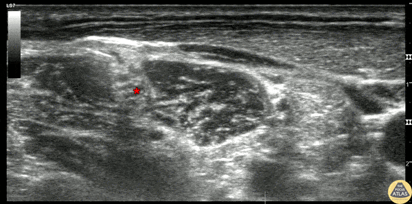Nerve Block Gallery - Interscalene Brachial Plexus Nerve Block