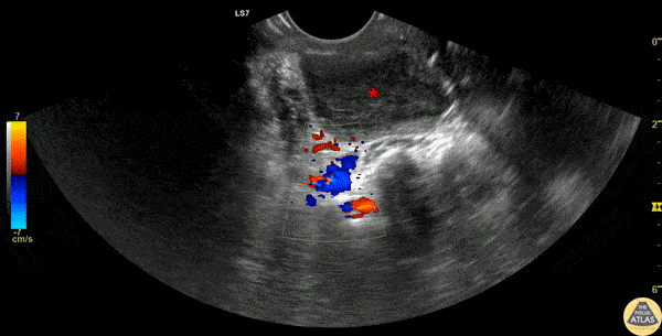 Soft Tissue - Peritonsillar Abscess Drainage