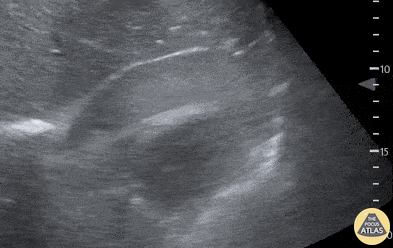 Pericardial Disease - Traumatic Tamponade