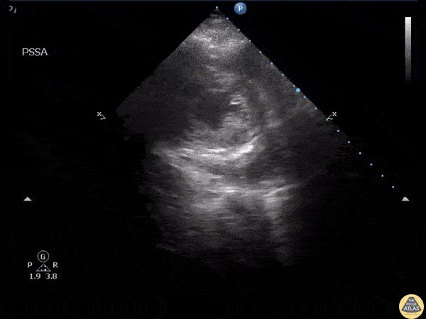 Pericardial Disease - Intrapericardial Hematoma