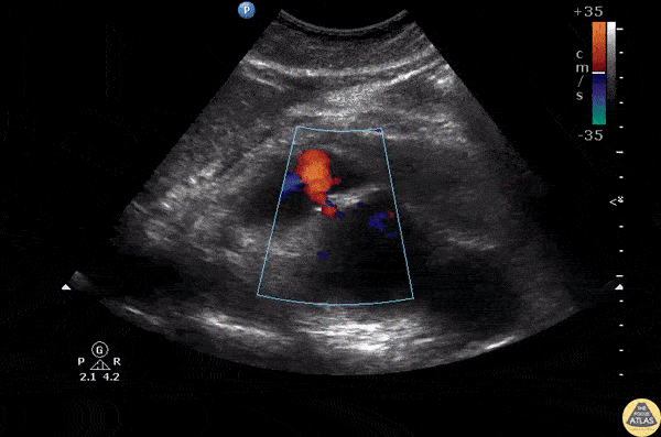 Aorta - Ruptured AAA