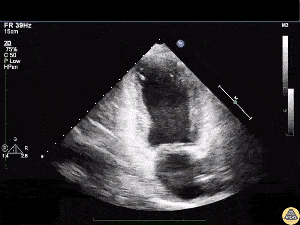 Left Ventricular Dysfunction - Takotsubo Cardiomyopathy on Apical Two Chamber View