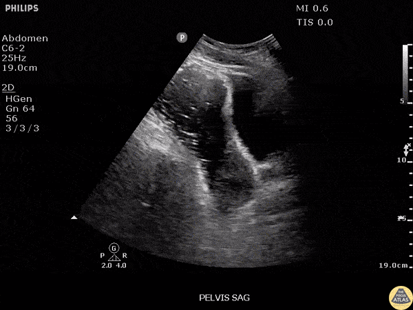Bowel-GI - Pelvic Free Fluid in Ruptured Appendicitis