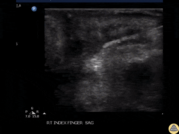 Soft Tissue - Foreign Body Removal