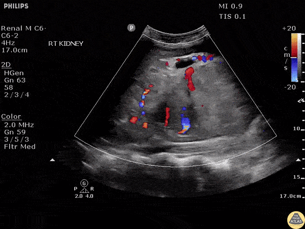 Renal/GU - Renal Cell Carcinoma
