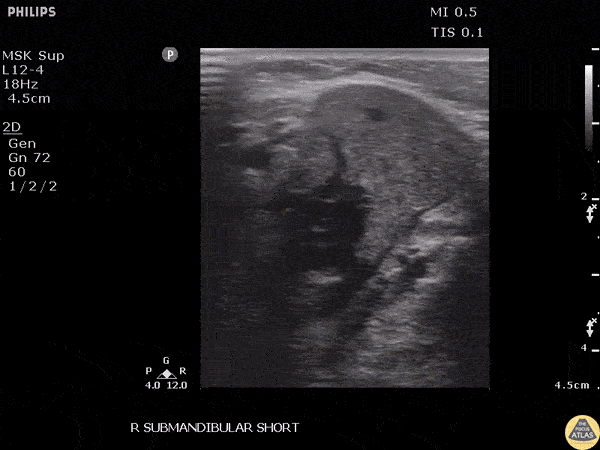 Soft Tissue - Submandibular Sialolithiasis