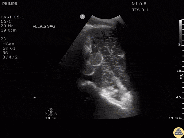 Bowel-GI - Pneumoperitoneum