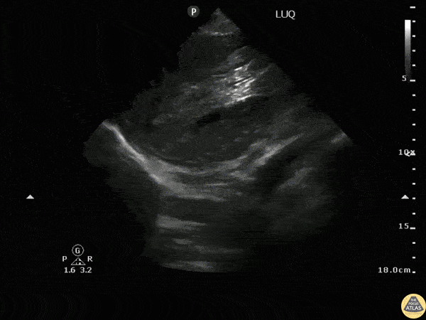 Trauma - Splenic Rupture