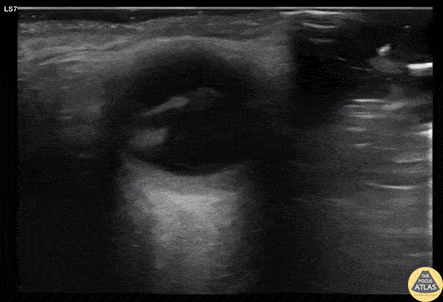 Orbital - Macula Off Retinal Detachment