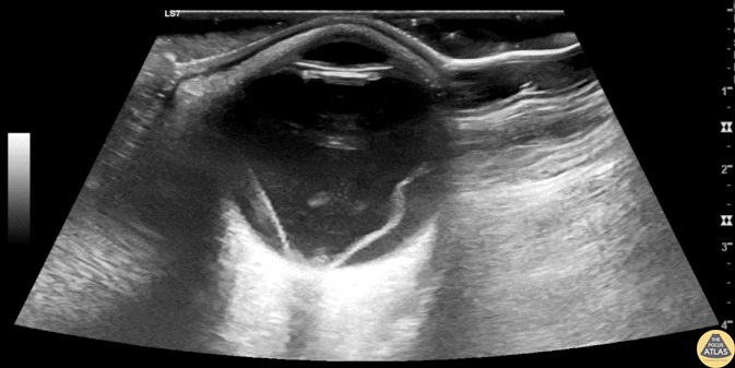 Orbital - Macula Off Retinal Detachment with Vitreous Hemorrhage