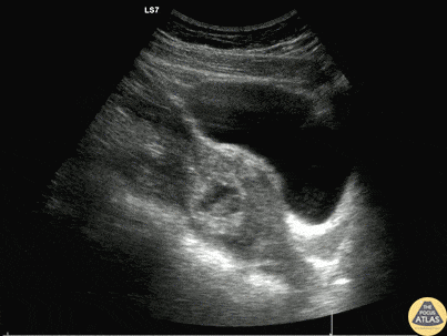 OB/Gyn - Ruptured Ectopic Pregnancy