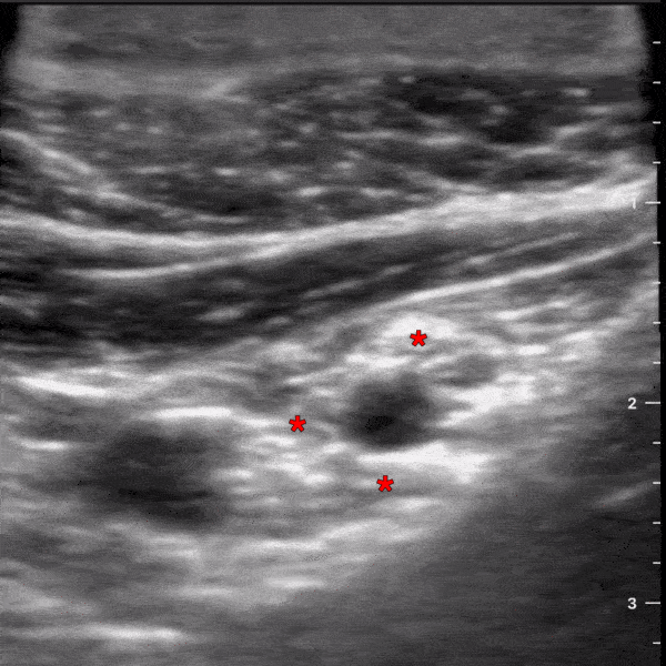 Nerve Block Gallery - Infraclavicular Brachial Plexus Block Anatomy