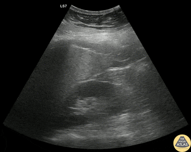 Trauma - Subtle RUQ +FAST