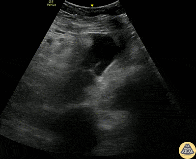 Trauma - Pelvic +FAST from Spleen Lac