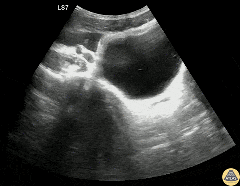 Trauma - Pelvic +FAST from Splenic Injury