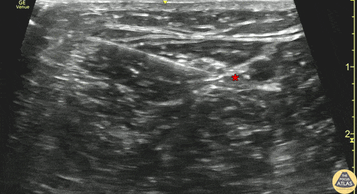 Nerve Block Gallery - Posterior Tibial Nerve Block for Heel Wounds