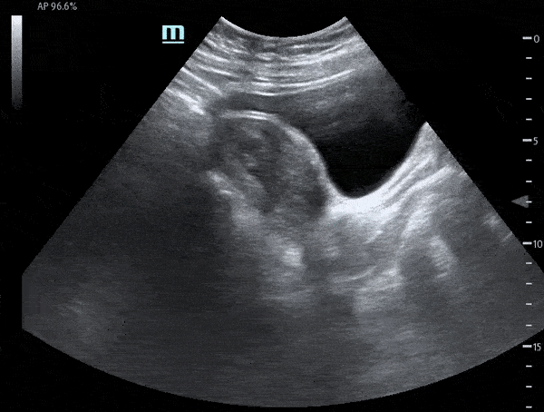 OB/Gyn - Fetal Pole with Cardiac Motion - Sagittal