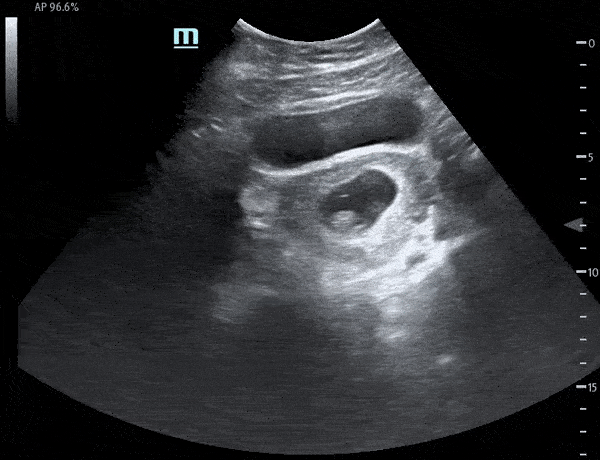 OB/Gyn - Fetal Pole with Cardiac Motion - Transverse