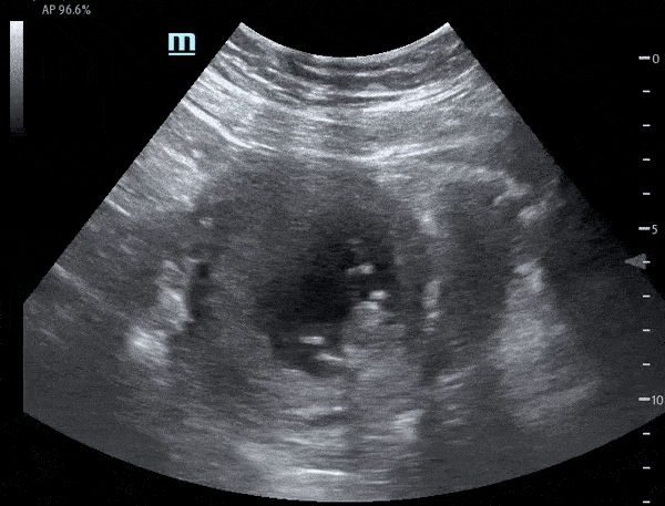 OB/Gyn - Early IUP with Fetal Motion and Cardiac Activity