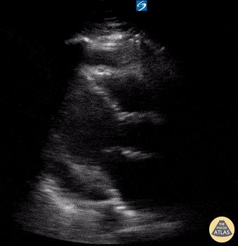 Pericardial Disease - Circumferential Pericardial Effusion