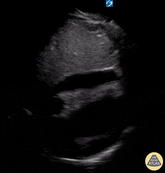 Pericardial Disease - Subxiphoid View of Pericardial Effusion
