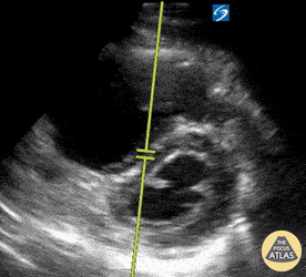 Right Ventricular Dysfunction - Septal Flattening in Saddle Pulmonary Embolism