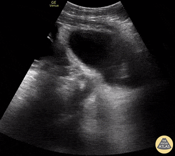 OB/Gyn - Ovarian Hyperstimulation Syndrome (OHSS)