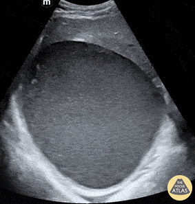 Biliary - Liver Hematoma
