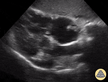 Right Ventricular Dysfunction - Clot in Transit