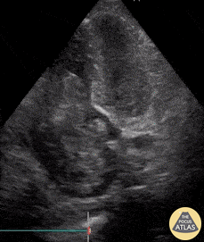 Cardiac Tumors - Cardiac Myxoma