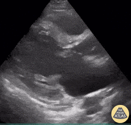 Valvulopathy - Mitral Valve Vegetation